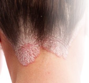 Ayurvedic Treatment Psoriasis