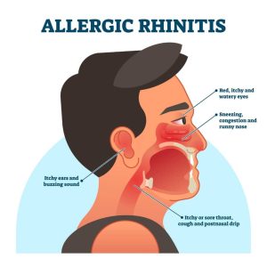 Allergic Rhinitis